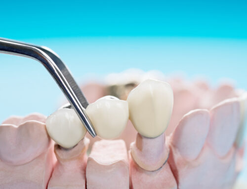 Fixed Dental Bridge – The Best Alternative to Dental Implants