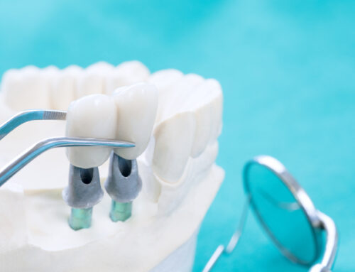 Why Should I Consider a Dental Implant to Replace My Missing Tooth?