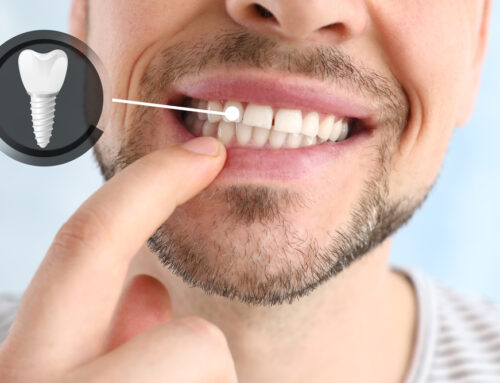 Everything You Want to Know About Dental Implants?